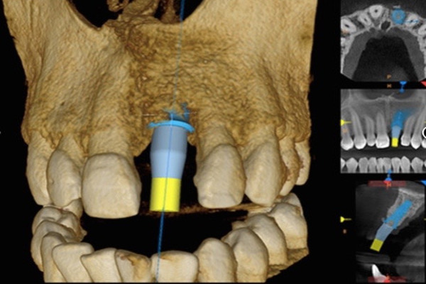 Implant Dentistry Smile Dental Care Dentist in Scotts Valley