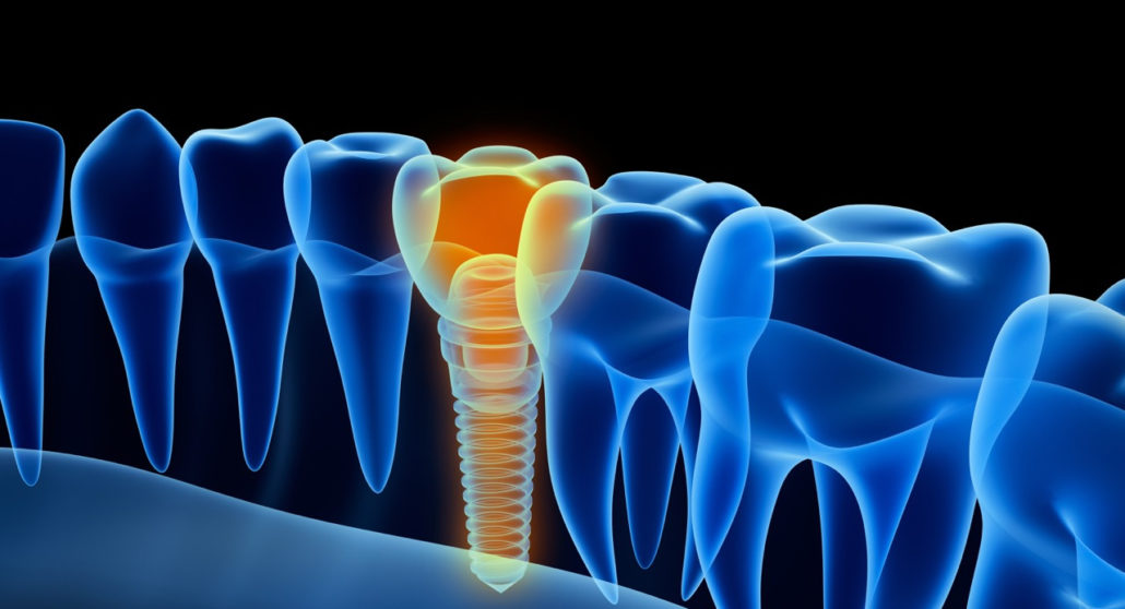 Implant Dentistry Smile Dental Care Dentist in Scotts Valley