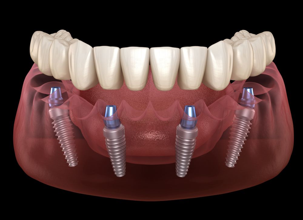 All On 4 8 Implants Smile Dental Care Dentist in Scotts