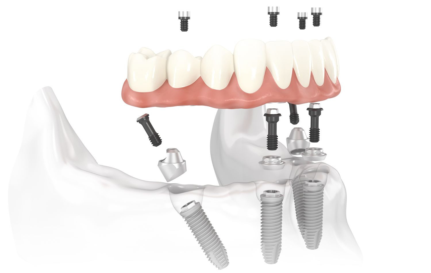 All-On-4 - Smile Dental